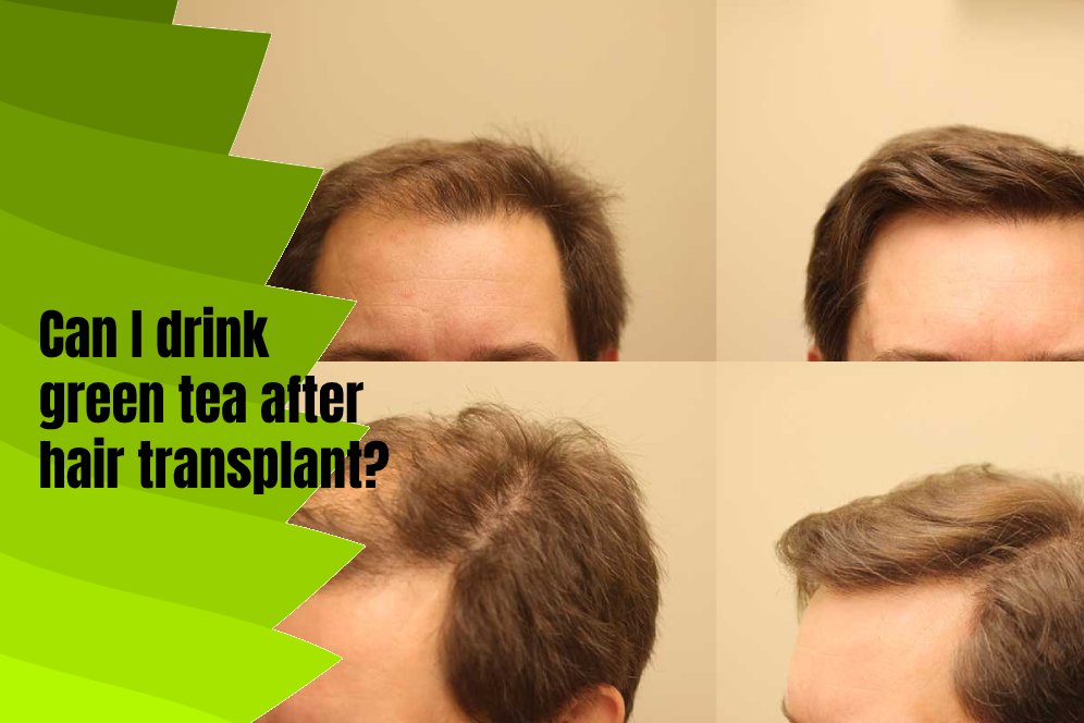 Can I drink green tea after hair transplant?