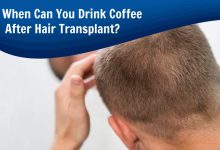 When Can You Drink Coffee After Hair Transplant? (Updated 2022)