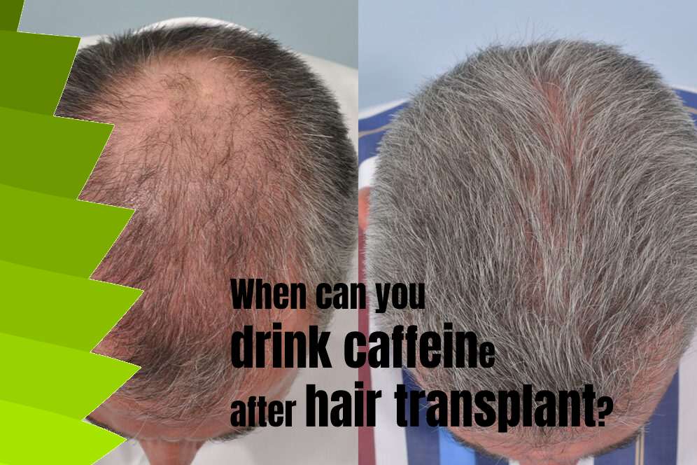 When can you drink caffeine after hair transplant? 