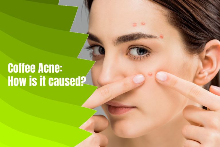 Does Coffee Cause Skin Acne?