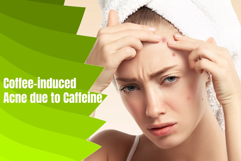 What is the Relation between Coffee and Acne